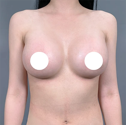 隆乳術後4