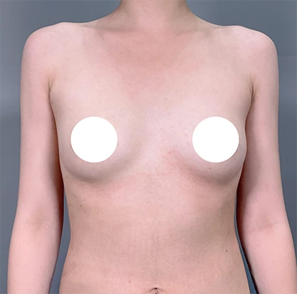 隆乳術前4