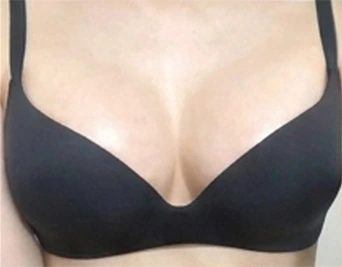 隆乳後穿著內衣照片1