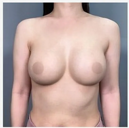 單側隆乳修復術後正面照 1
