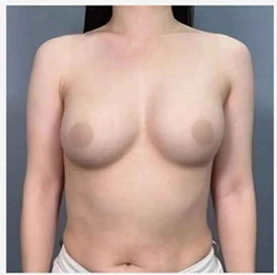 單側隆乳修復術前正面照 1