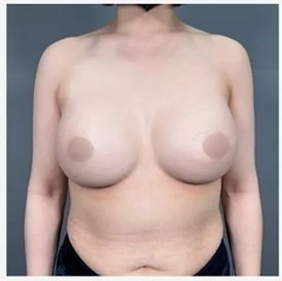單側隆乳修復術後正面照 2