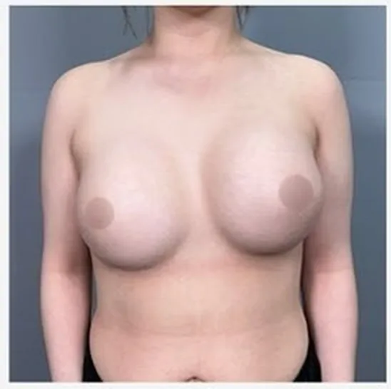 單側隆乳修復術前正面照 2