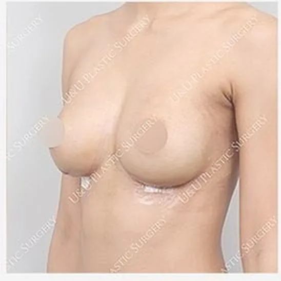 單側隆乳修復術後側面照 3