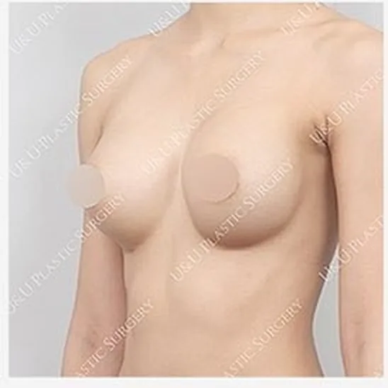 單側隆乳修復術前側面照 3