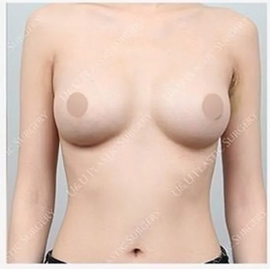 單側隆乳修復術後照片 5