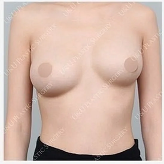 單側隆乳修復術前照片 5