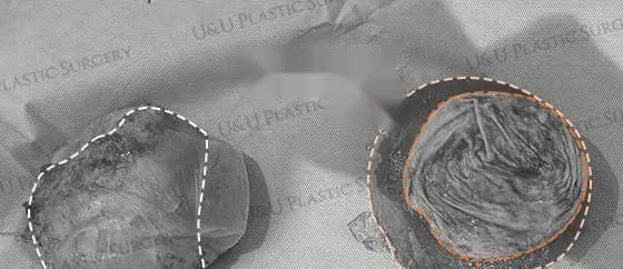 並排呈現以整塊方式移除的莢膜與破裂義乳之檢體照
