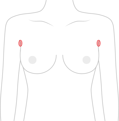 乳房手術