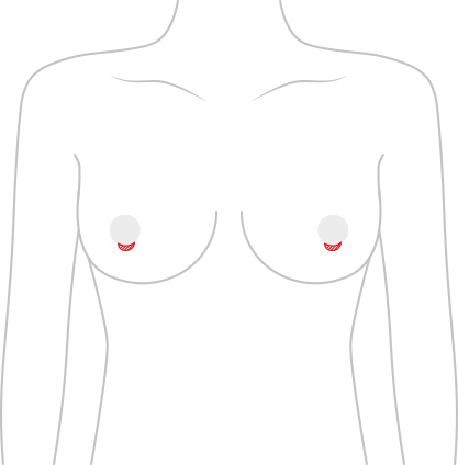 隆乳修復手術
