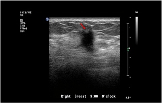 Healthy Breast乳癌超音波img11 m